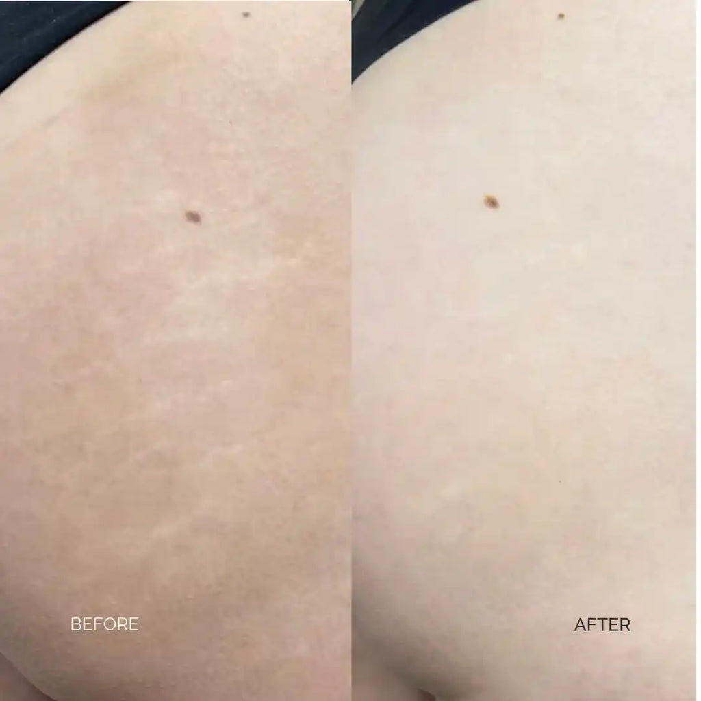 Markaway Stretch Mark Serum 30ml – Herbal Hydration & Skin Tone Repair